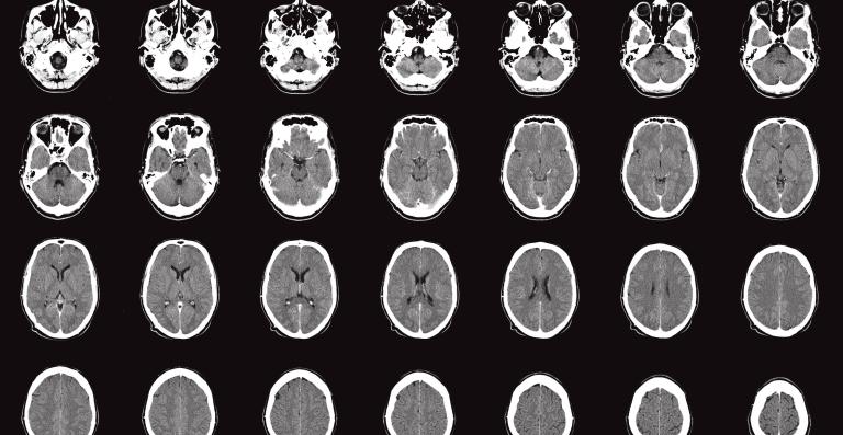 Computer tomography scan of a human brain, from the base of the skull to the top. Uppsala Uppsala University Hospital, Department of Radiology. Image altered.